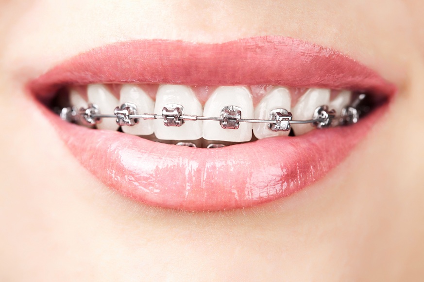 Orthodontics - Braces - Advance Dental Care Chatswood