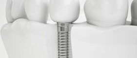 Implant Dentistry - Advance Dental Care Chatswood